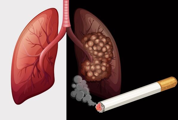 Raucherlungen und gesunde Lungen